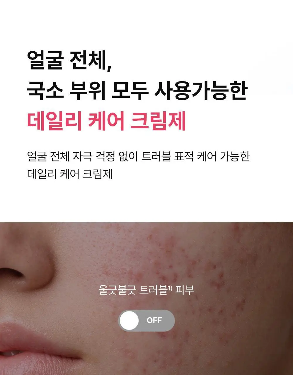[트러블표적케어] 동아제약 아크네 프로 크림제 30ml 상세페이지 9